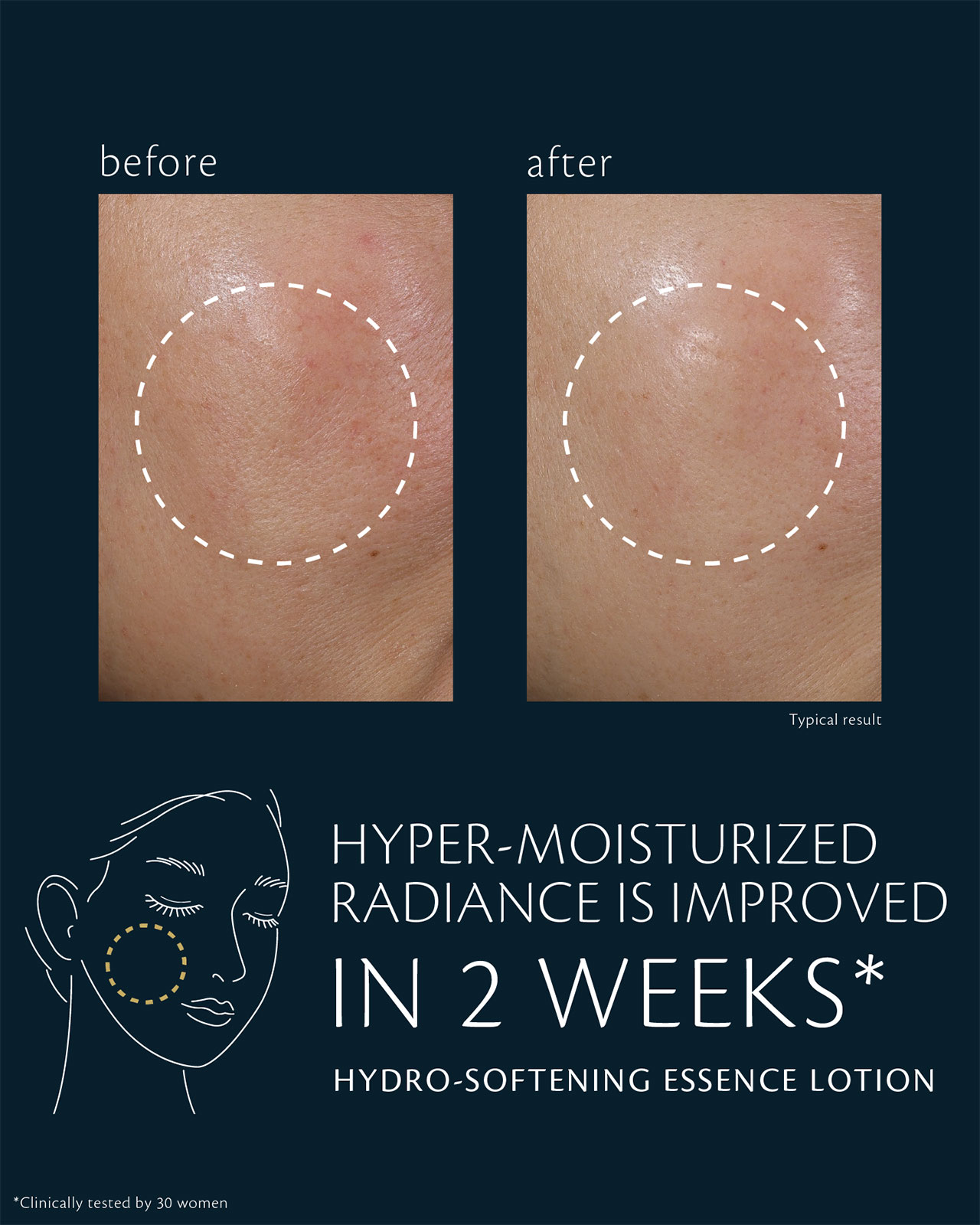 Photo of clinical test results for HYDRO-SOFTENING ESSENCE LOTION on 30 women, showing improved radiance after 2 weeks and enhanced moisture retention after 4 weeks. The image compares cheek areas before and after use, with the circled areas showing a visibly smoother and more hydrated appearance.
