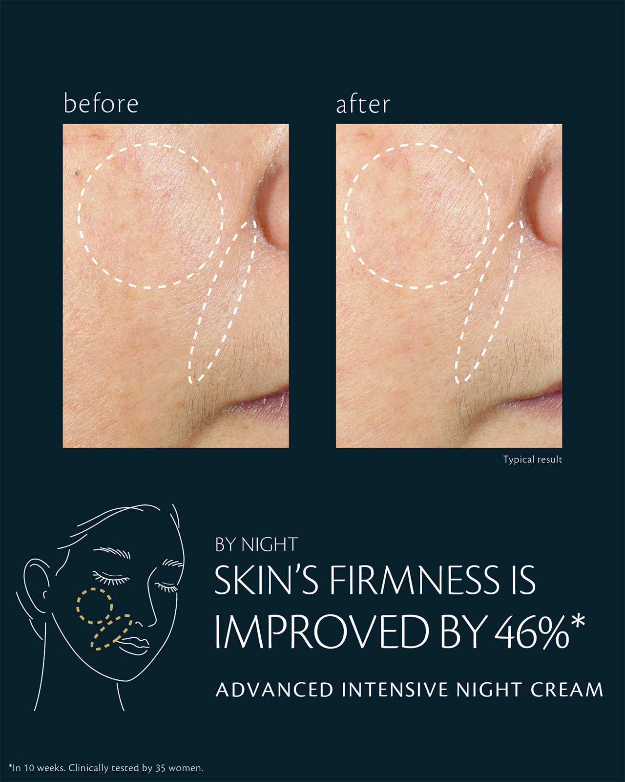 Photo of before-and-after comparison of cheek skin condition using ADVANCED INTENSIVE NIGHT CREAM. The left &ldquo;before&rdquo; image shows a lack of firmness, while the right &ldquo;after&rdquo; image shows a 46% improvement in firmness. Based on a 10-week clinical test with 35 women.