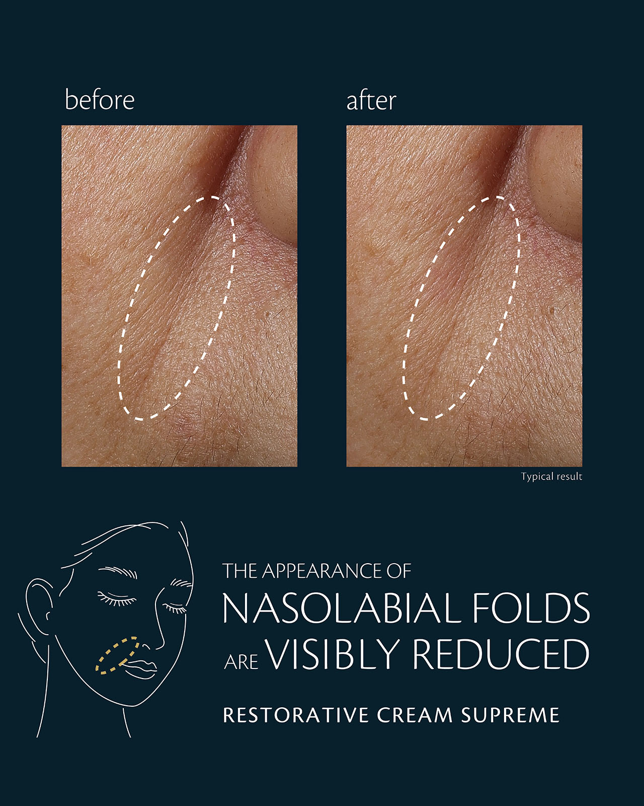Photo showing a before and after comparison of nasolabial folds with the text: THE APPEARANCE OF NASOLABIAL FOLDS ARE VISIBLY REDUCED. RESTORATIVE CREAM SUPREME. Typical result. Includes a diagram of a face indicating the targeted area.